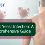 Men’s Yeast Infection: A Comprehensive Guide